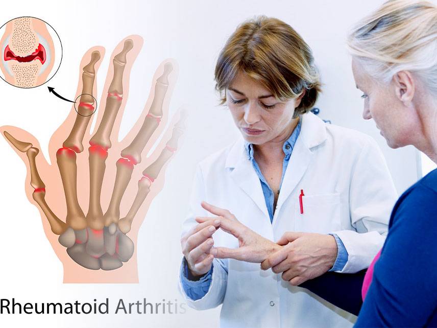 Qué es la artritis reumatoide: síntomas, diagnóstico, tratamiento.